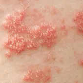 Shingles
